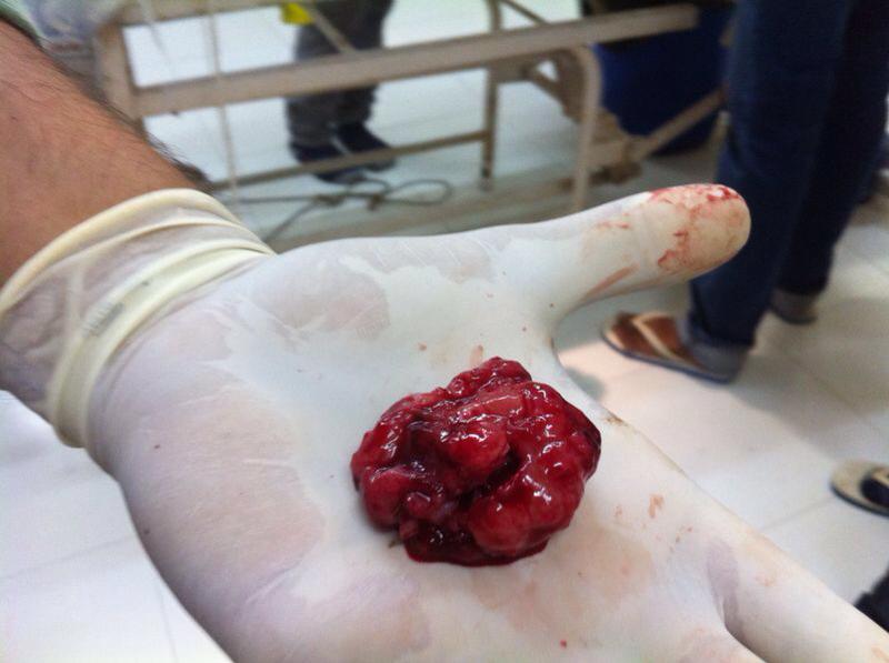 The tumor of the dog removed 